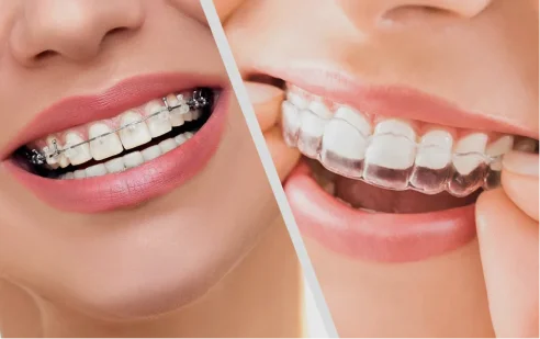 Invisalign®  